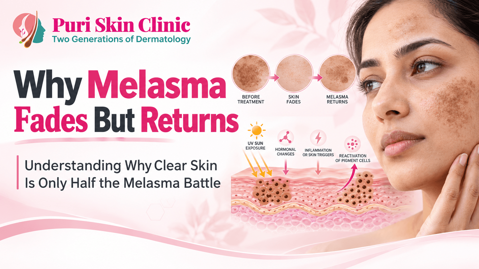 Why Melasma Fades But Returns: Understanding Why Clear Skin Only Half the Melasma Battles?